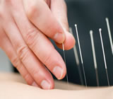 acupuntura-no-Consolação